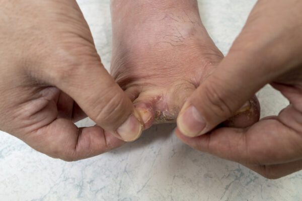 Image of a foot affected by Athlete's foot (Tinea pedis)